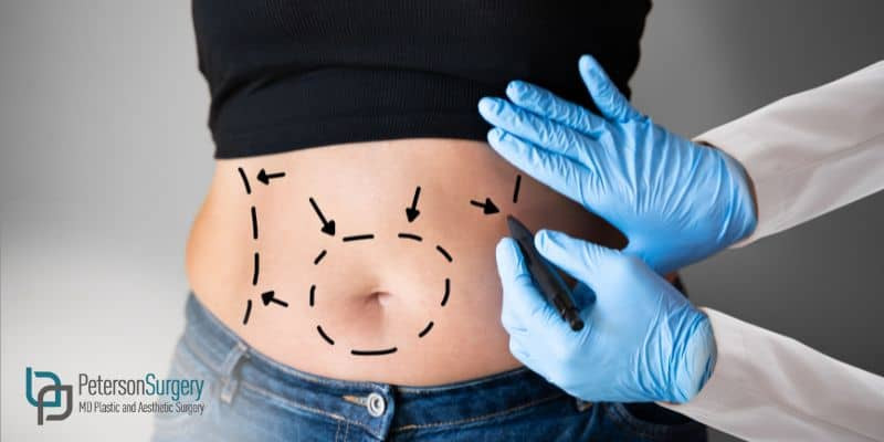 After A Tummy Tuck A Recovery Timeline